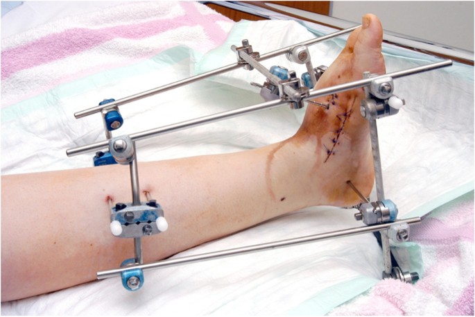 Limb Reconstructive & Deformity Correction Surgery